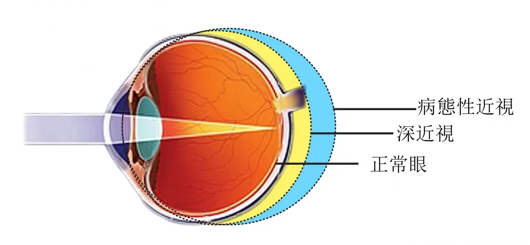 伴隨著眼軸的增長,高度近視的人眼底比一般人脆弱,提前發生白內障