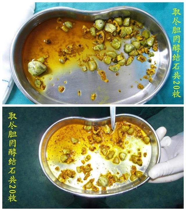 得了胆结石是切还是保请听医生说