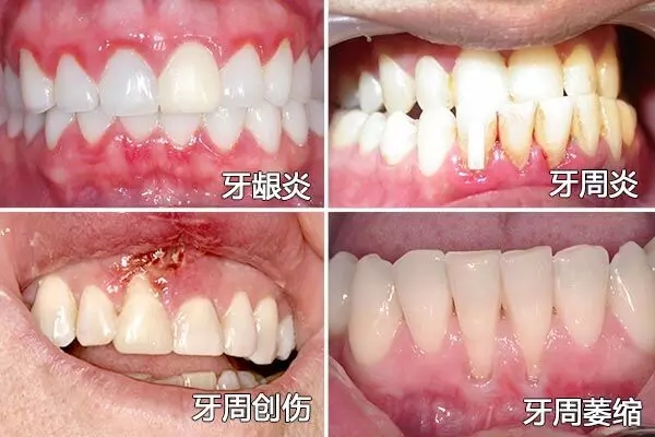 包括牙龈出血红肿,牙龈增厚变肥,牙龈退缩,牙周袋深度加深,牙周溢脓