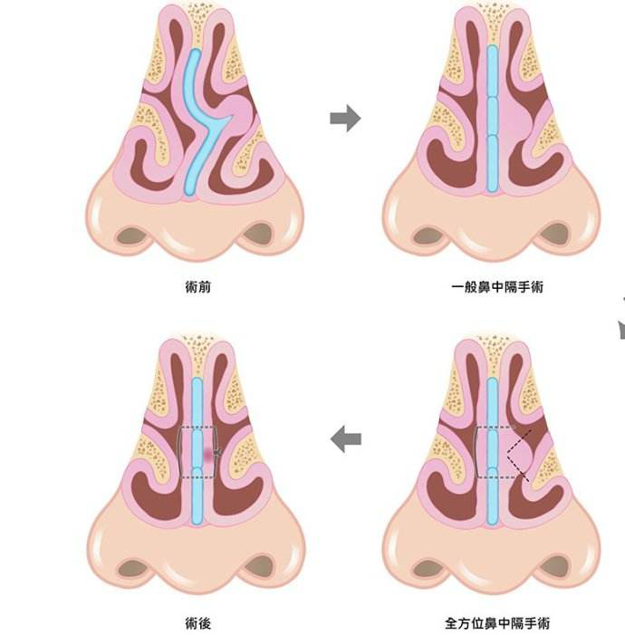 鼻整形可以矯正鼻中隔偏曲嗎?