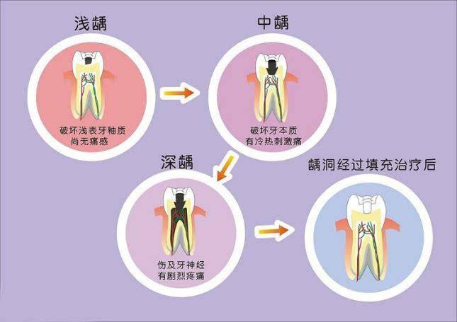 科普齲齒是牙齒生蟲嗎應該怎麼辦