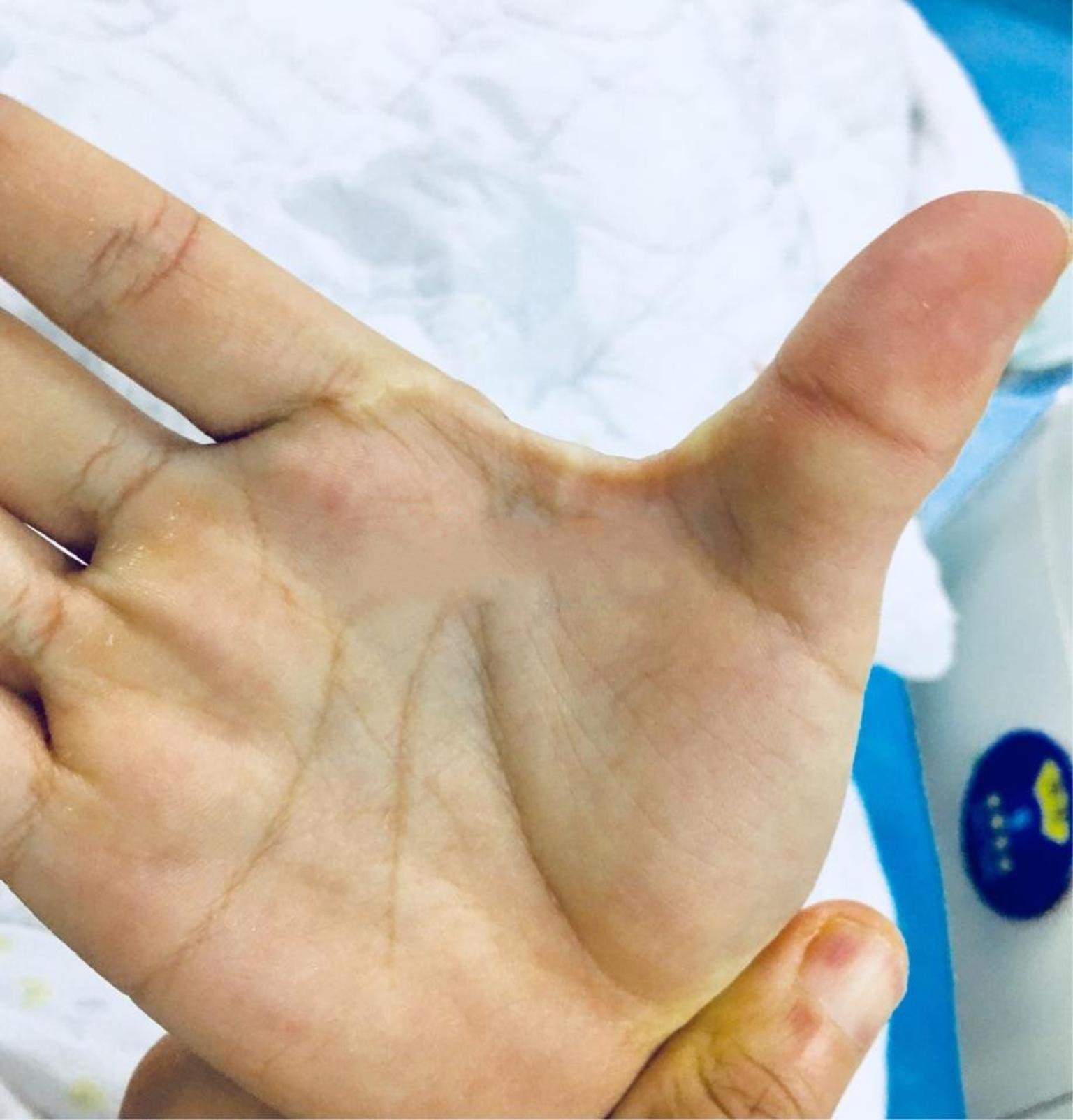 如何"完美的"松解手部虎口的疤痕挛缩组织-朱伟主任医师-爱问医生