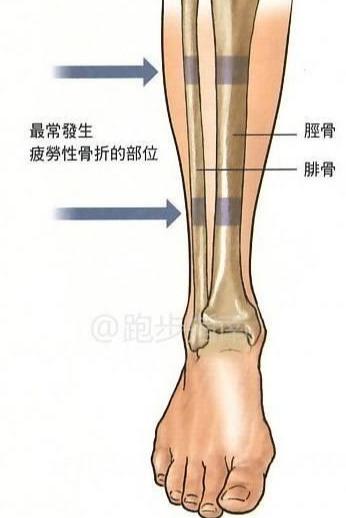 常见骨折胫腓骨骨折是什么呢?日常生活中该怎样去避免?