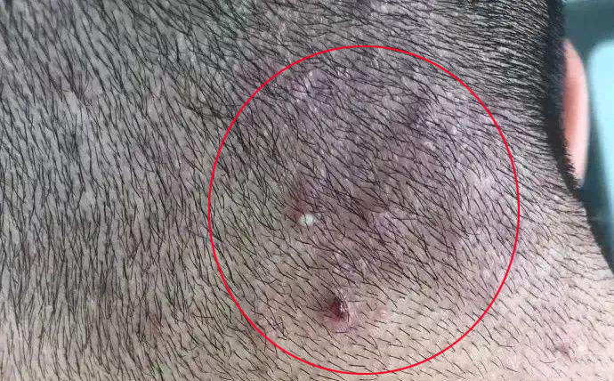 头皮上扣下来的白色颗粒物是啥