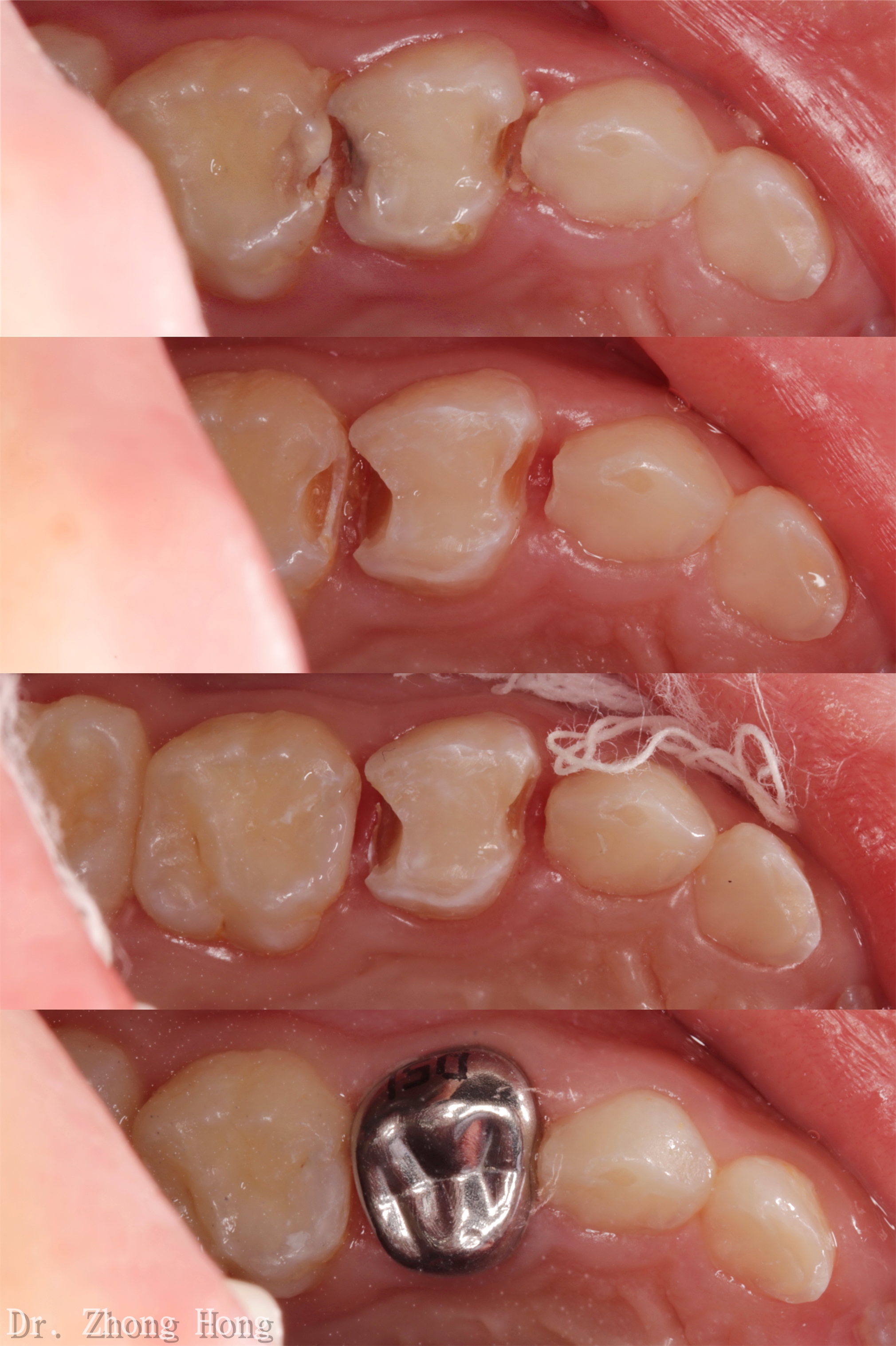 乳牙开髓洞形图片