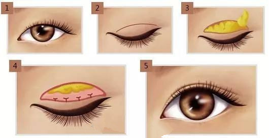 无论是哪种类型的肿眼泡,都可以经过手术方法进行矫正并与双眼皮手术