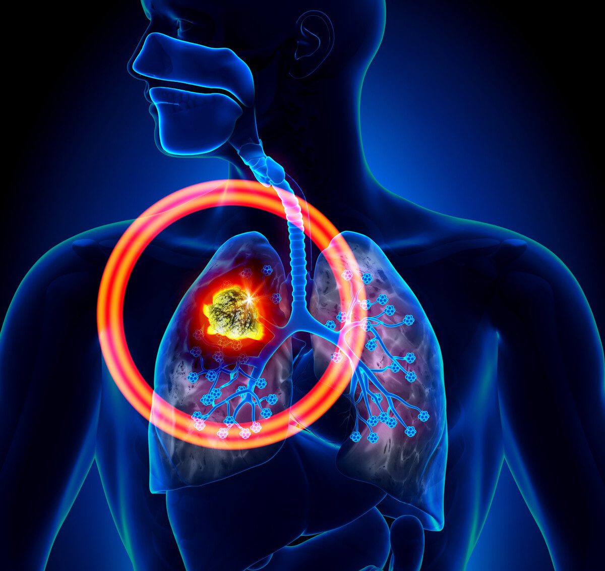 为什么早期肺癌难以发现，出现以下五个症状，最好去检查下肺部CT