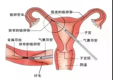 输卵管堵塞双侧图片