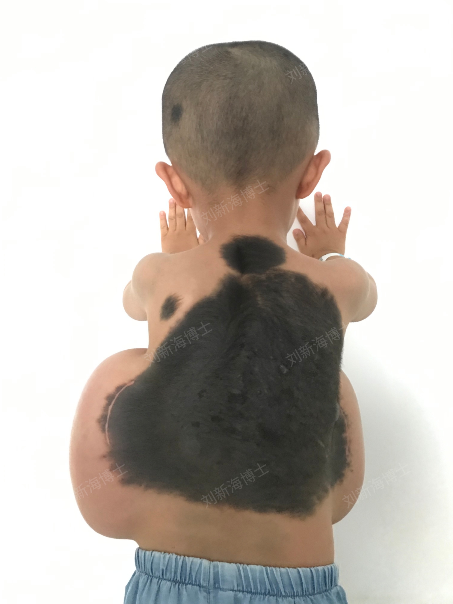 背部黑痣巨痣皮肤扩张培养带去希望