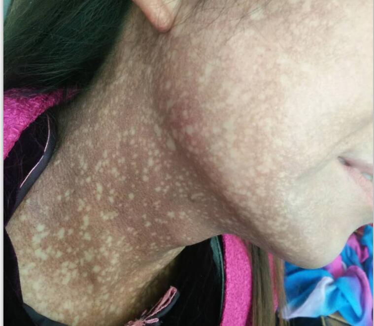 中医是如何辨证分型治疗皮肤黑变病的?-李志忠主治医师-爱问医生