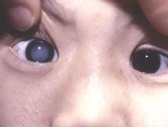 瘤等都可能是变白的原因; 2,有的孩子可能大小眼,两个眼睛不一样大