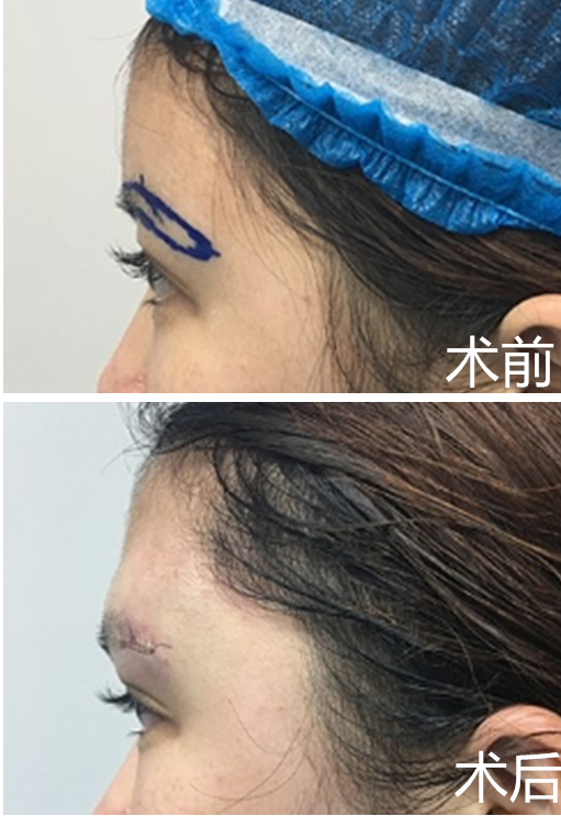 关于假体垫眉弓术常见问题