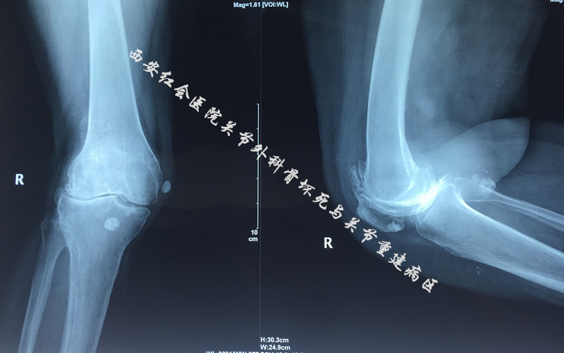 雙膝骨性關節炎漸進性加重20年治療