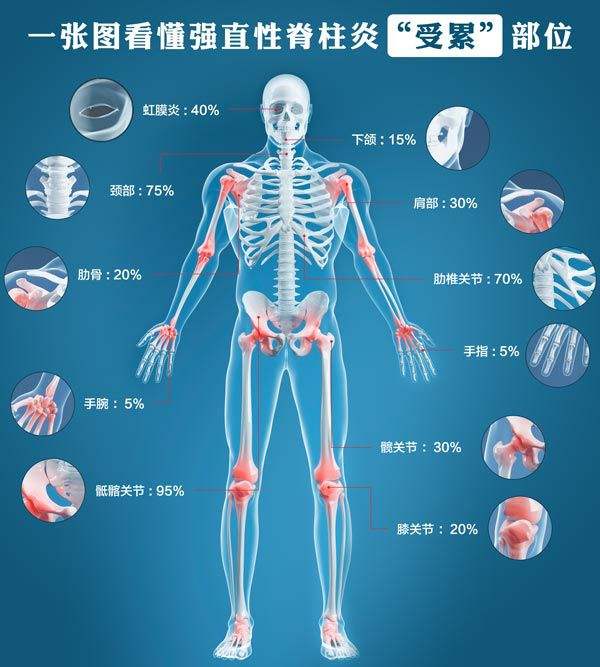 強直性脊柱炎中期了,該怎麼辦呢?