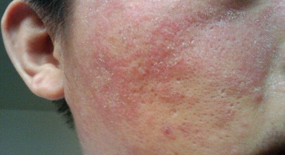 皮炎往往伴发红疹,使皮肤看起来油腻,发红,还会出现干燥和鳞屑等症状