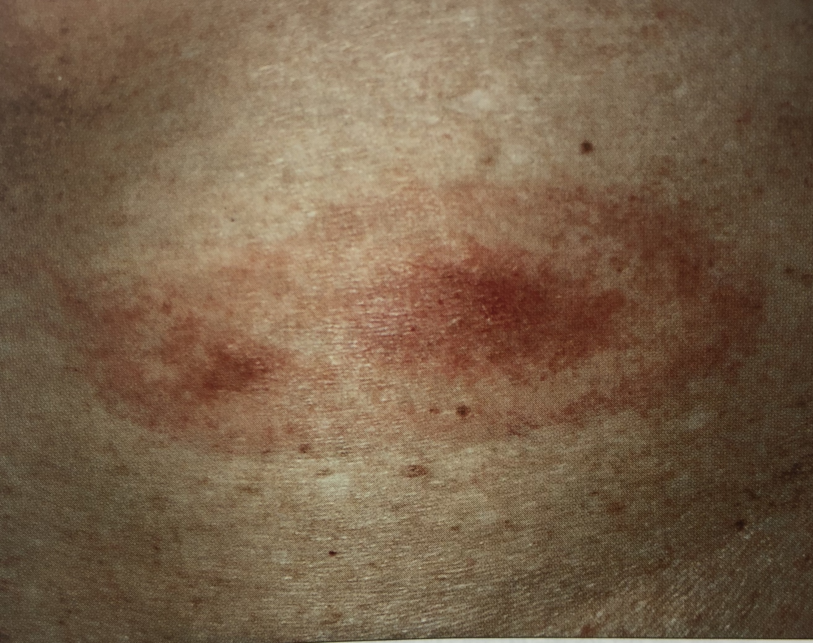 离心性环状红斑癌症图片
