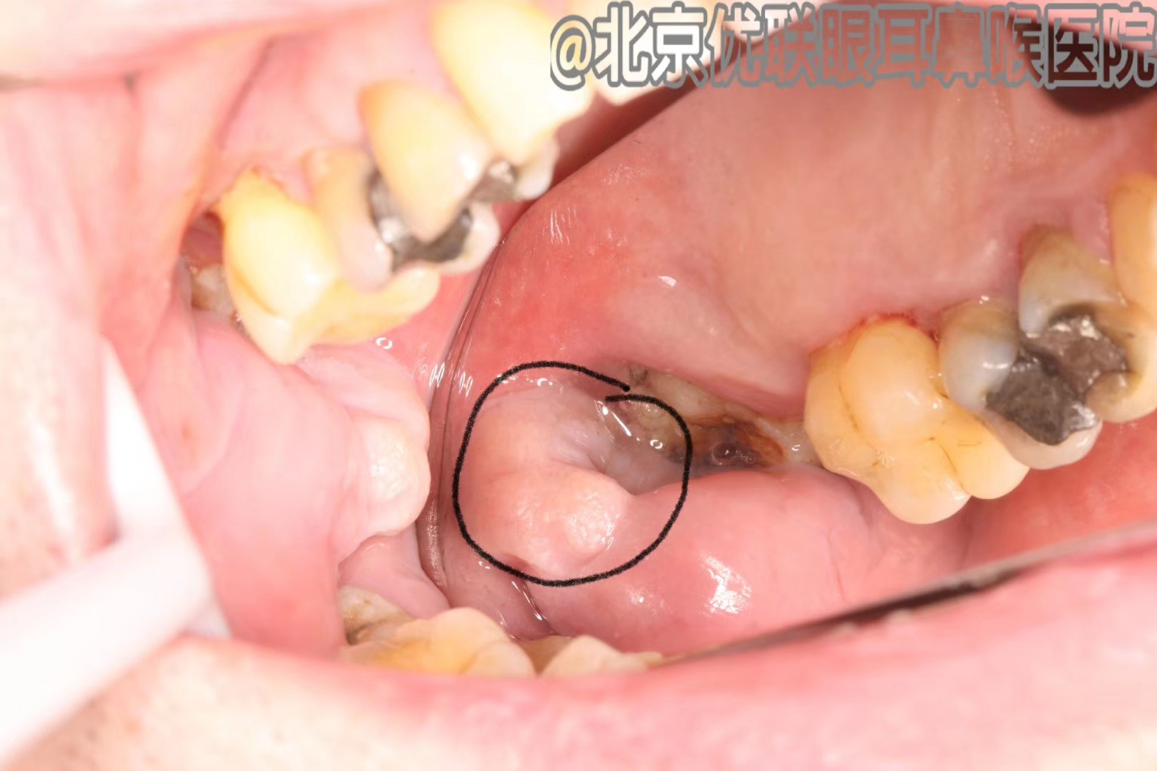 对于口腔内的白斑要早做病理
