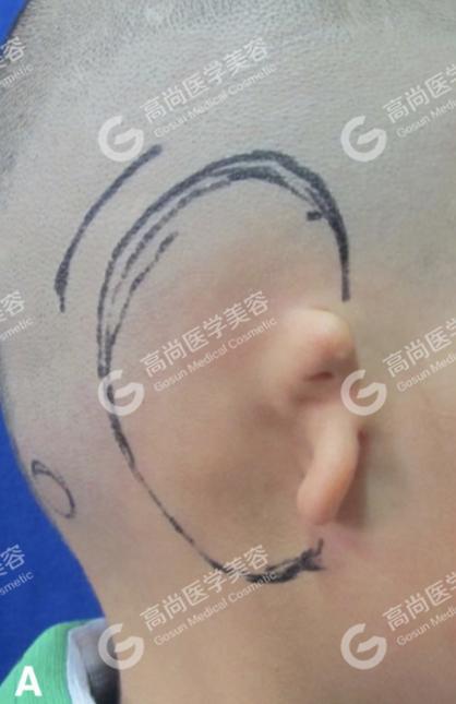 耳再造术后即刻效果一起见证耳朵的神奇变化