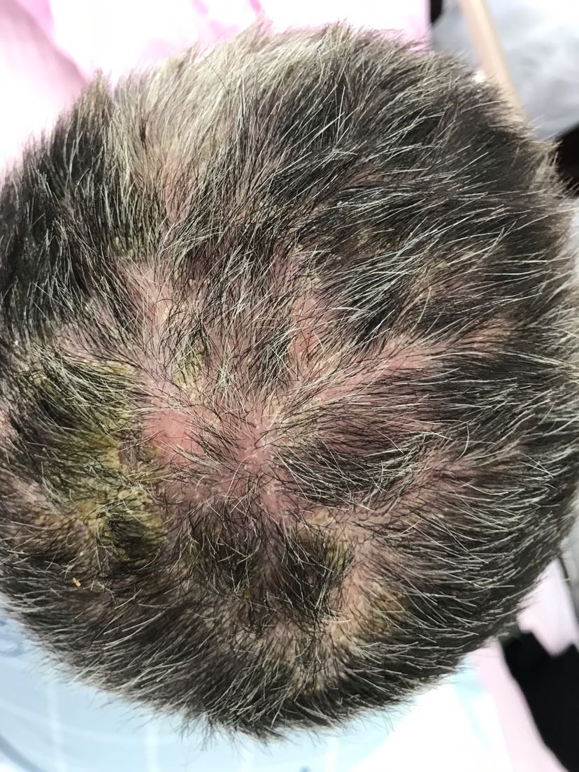 螨虫-马尊峰主治医师-爱问医生