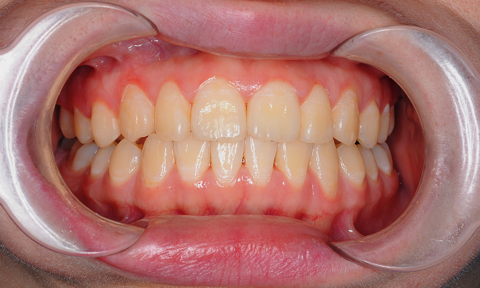 天津牙齿矫正常见错颌畸形之牙列拥挤