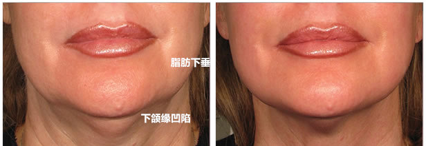 下颌缘凹陷-face-3_副本.jpg