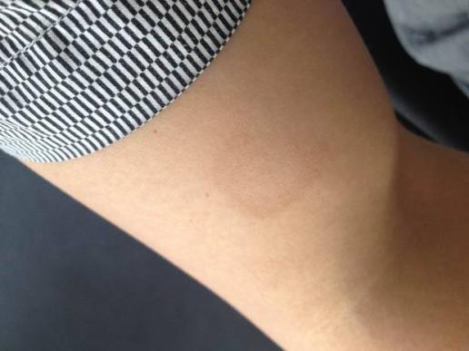 离心性红斑怎么治?&nbsp;发病过程.&nbsp;愈合后无疤痕? - 爱问知识人