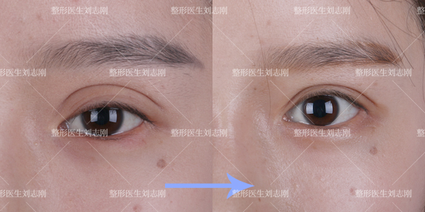 首选外眦开大术