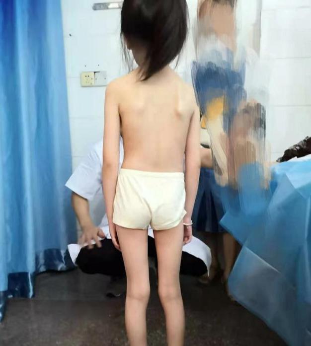 一个小女孩脊柱侧弯是长短腿引起的,要怎么办呢?
