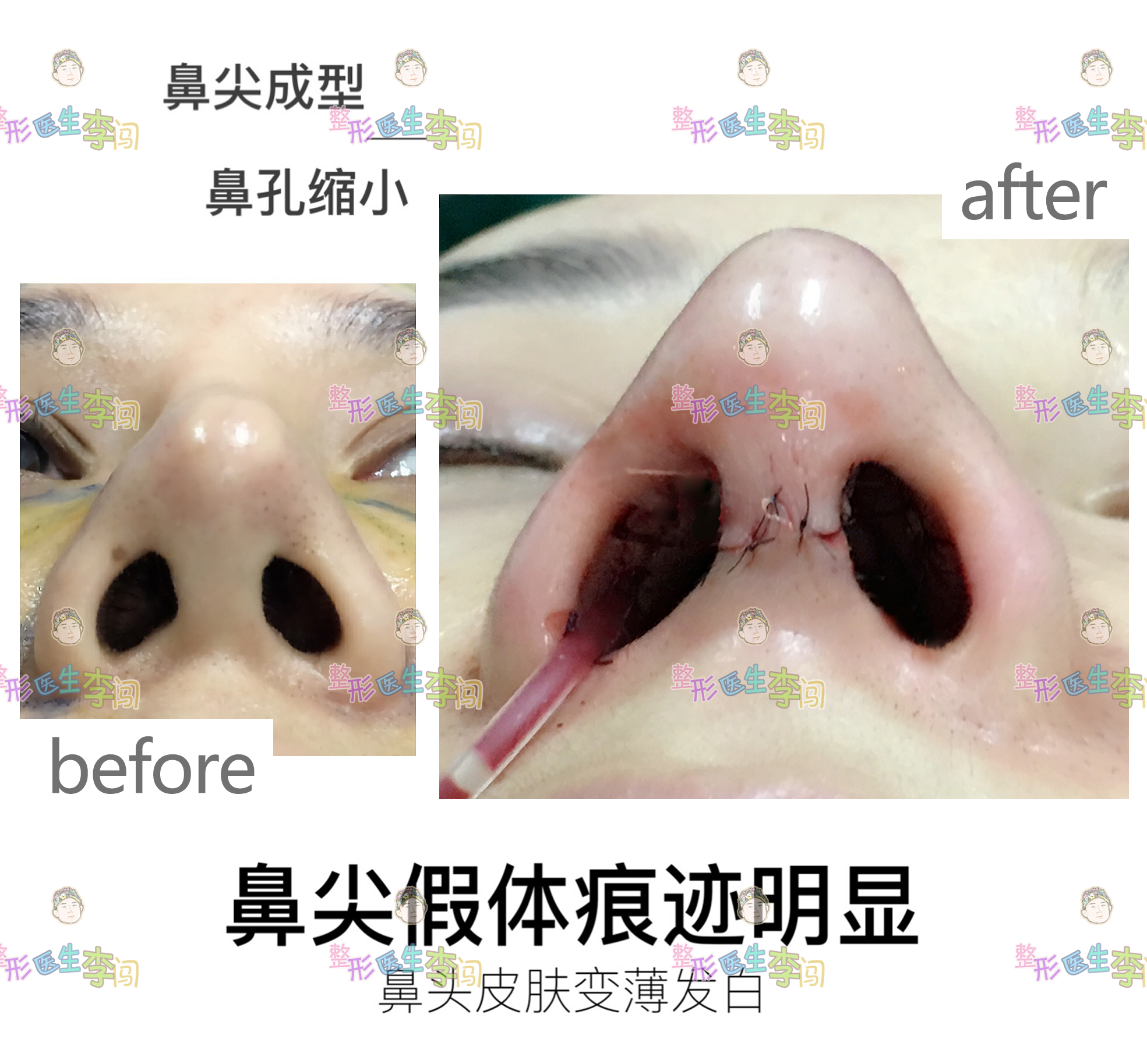 因为将塌鼻子垫高,相对要用更厚的假体,那么皮肤就很容易被