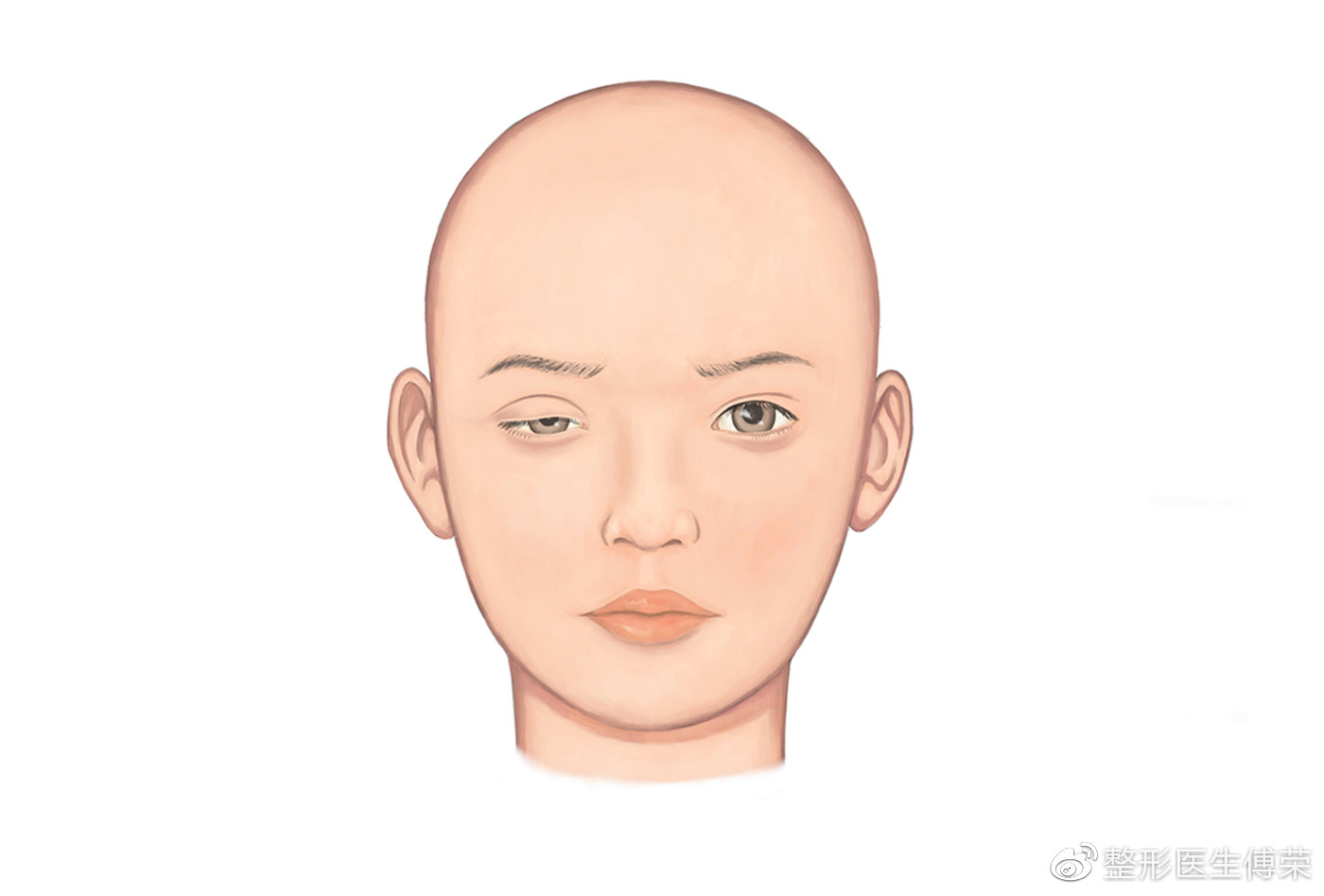 为什么有些人做完上睑下垂之后眼睑闭合不全?