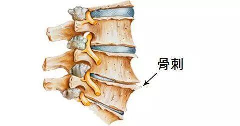 颈椎骨质增生就是得了颈椎病吗?