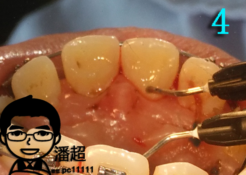 深覆合是啥需不需矫正附固定树脂平导制作过程