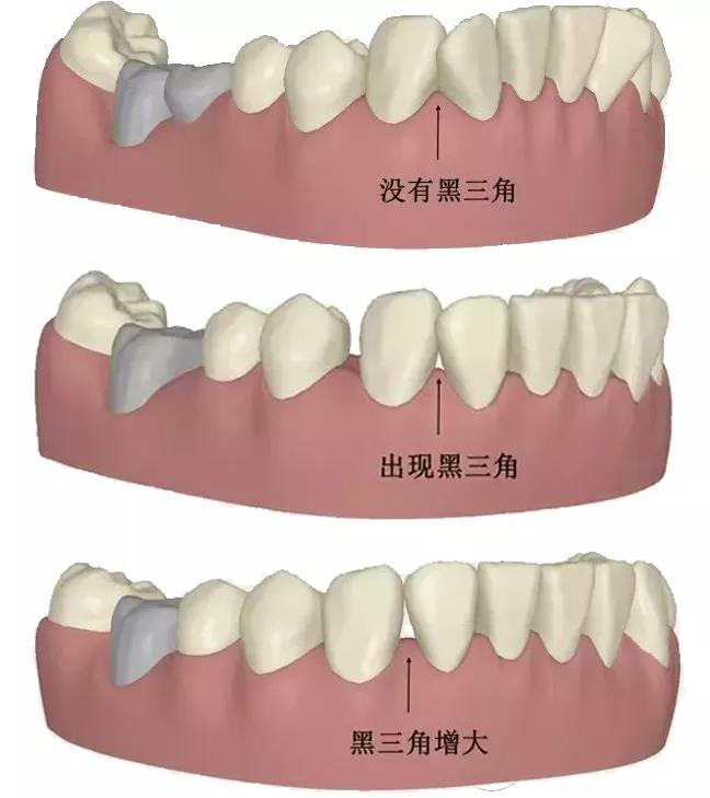 黑三角真的是牙齿矫正引起的吗?看完想跟牙套道个歉