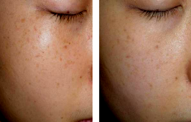 色斑分为表皮型色斑,真皮型色斑和混合型色斑,即雀斑,咖啡斑,老年斑