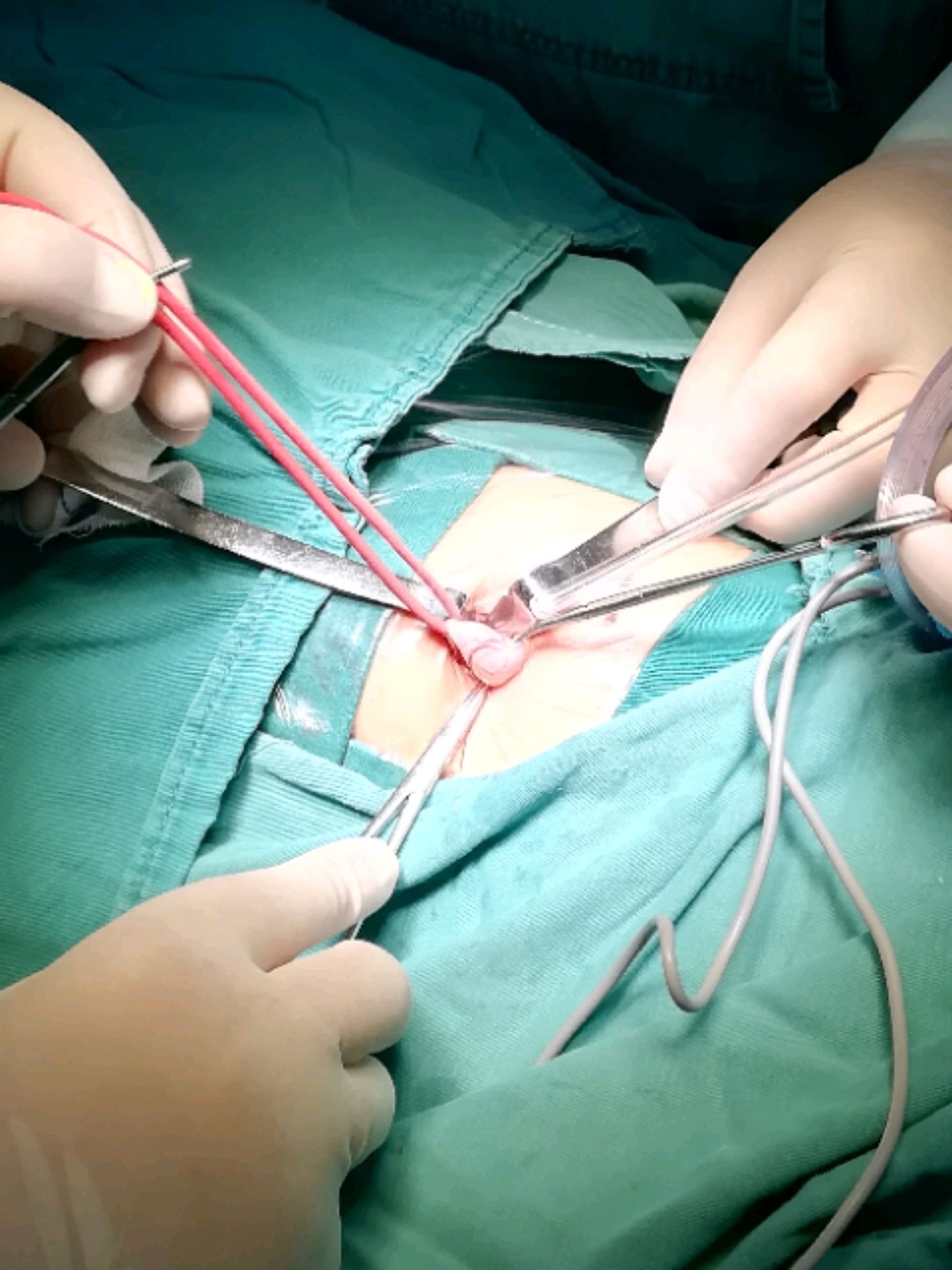 肾结石插管手术图图片