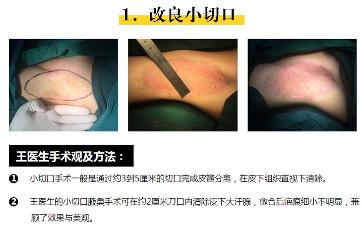 通过一个小的刀口一般是1.