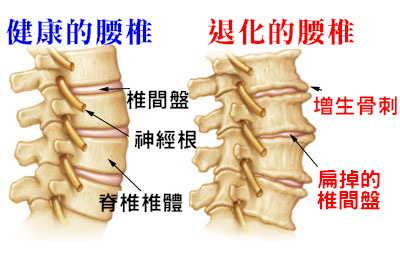 颈椎腰椎疼痛当心脊柱骨刺教你正确缓解症状