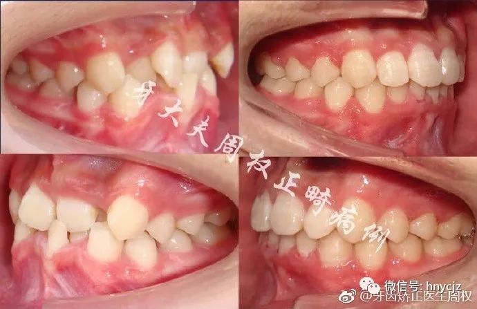 发现即需矫正12岁前必须处理的20种儿童牙颌畸形