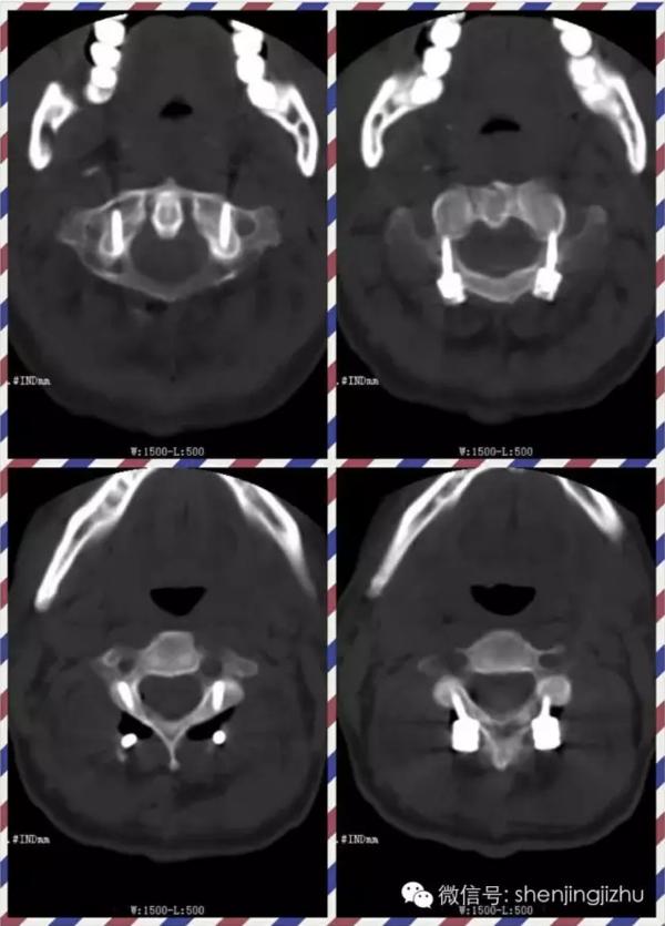 病例分享枢椎齿状突ii型骨折