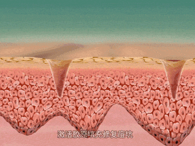 其他的还有非气化型点阵激光促进新的胶原形成,一般进行 5 ～ 8 次