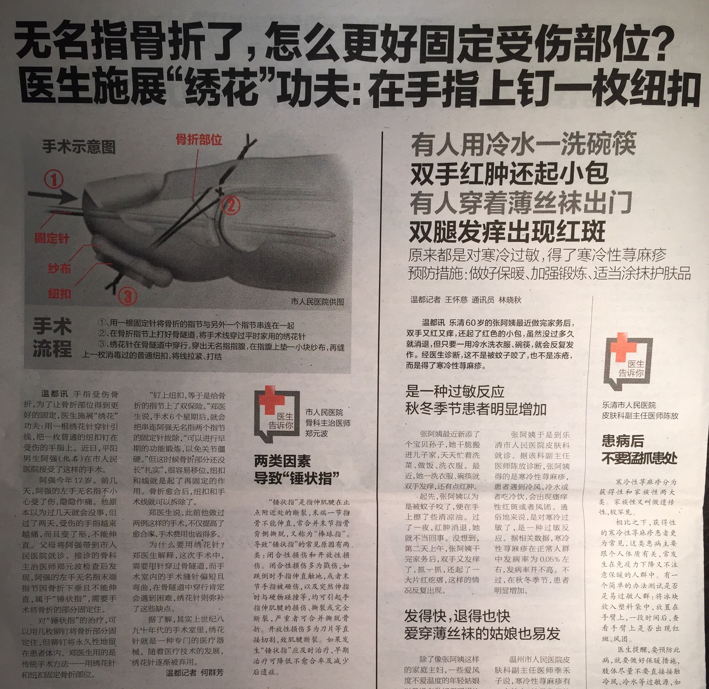 整形显微001在手指头上钉纽扣骨性锤状指的经典手术治疗