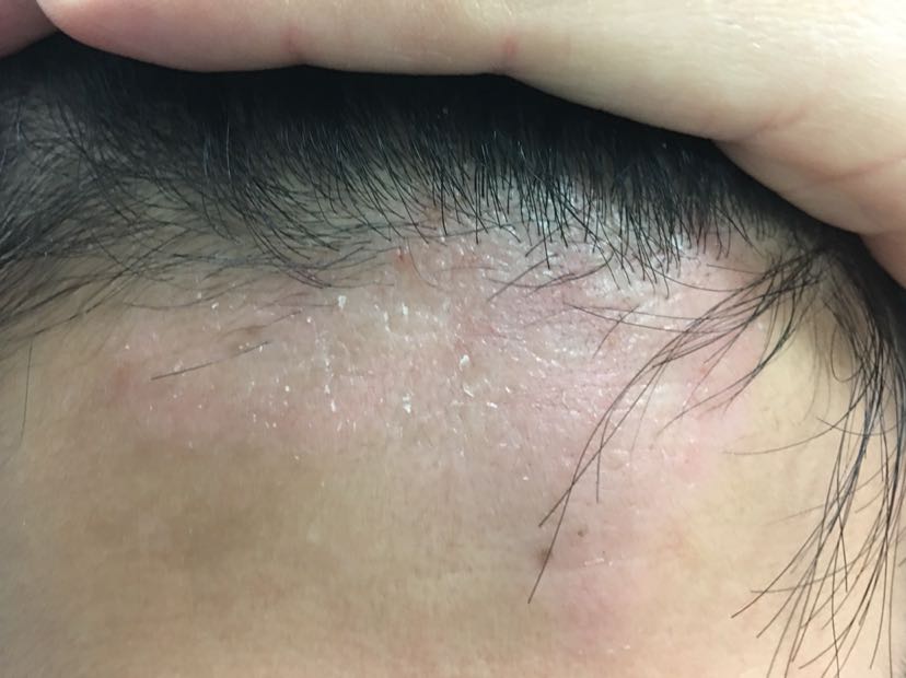 皮肤病的诊断和鉴别诊断也是很复杂的一个病在治疗了