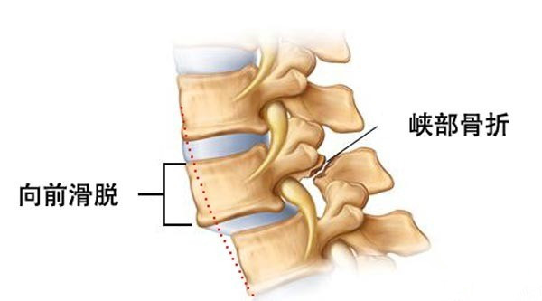 腰椎滑脱症