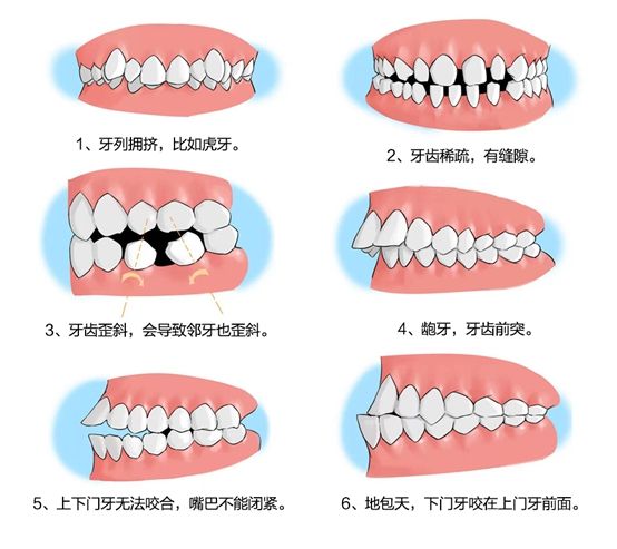 易致牙頜畸形1,吸吮手指習慣導致開牙合畸形以及牙弓狹窄,顎蓋高拱,上