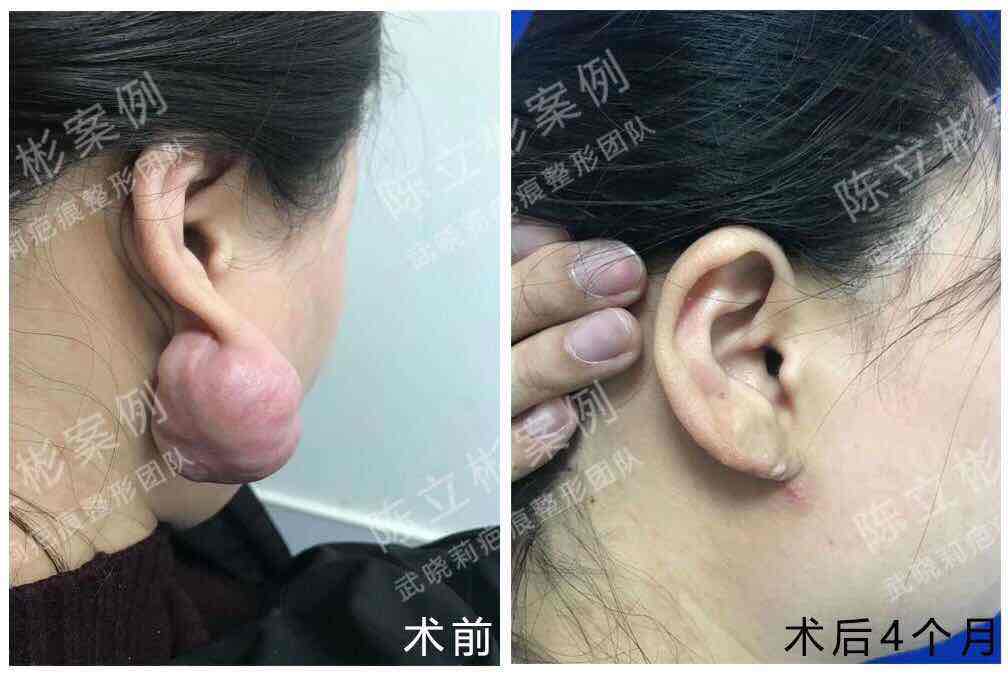 女性,27岁,今年2月局麻下行#双耳耳垂疤痕疙瘩# 切除 ,术后配合放疗