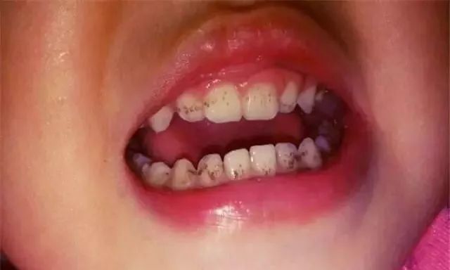 清除这类污渍的同时,也能去除口腔里的牙菌斑和牙结石,这些都是导致