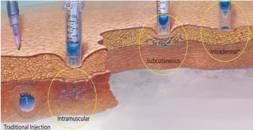 疤痕疙瘩注射疼痛难忍无针注射新技术即将来临