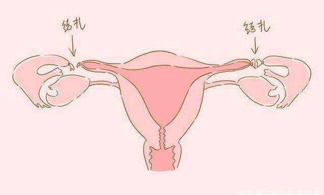 第三,输卵管结扎术有可能会影响卵巢血供,从而影响卵巢功能.