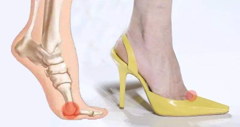 拇外翻十二问,这些您都知道吗?-翁凯淋副主任医师-爱问医生