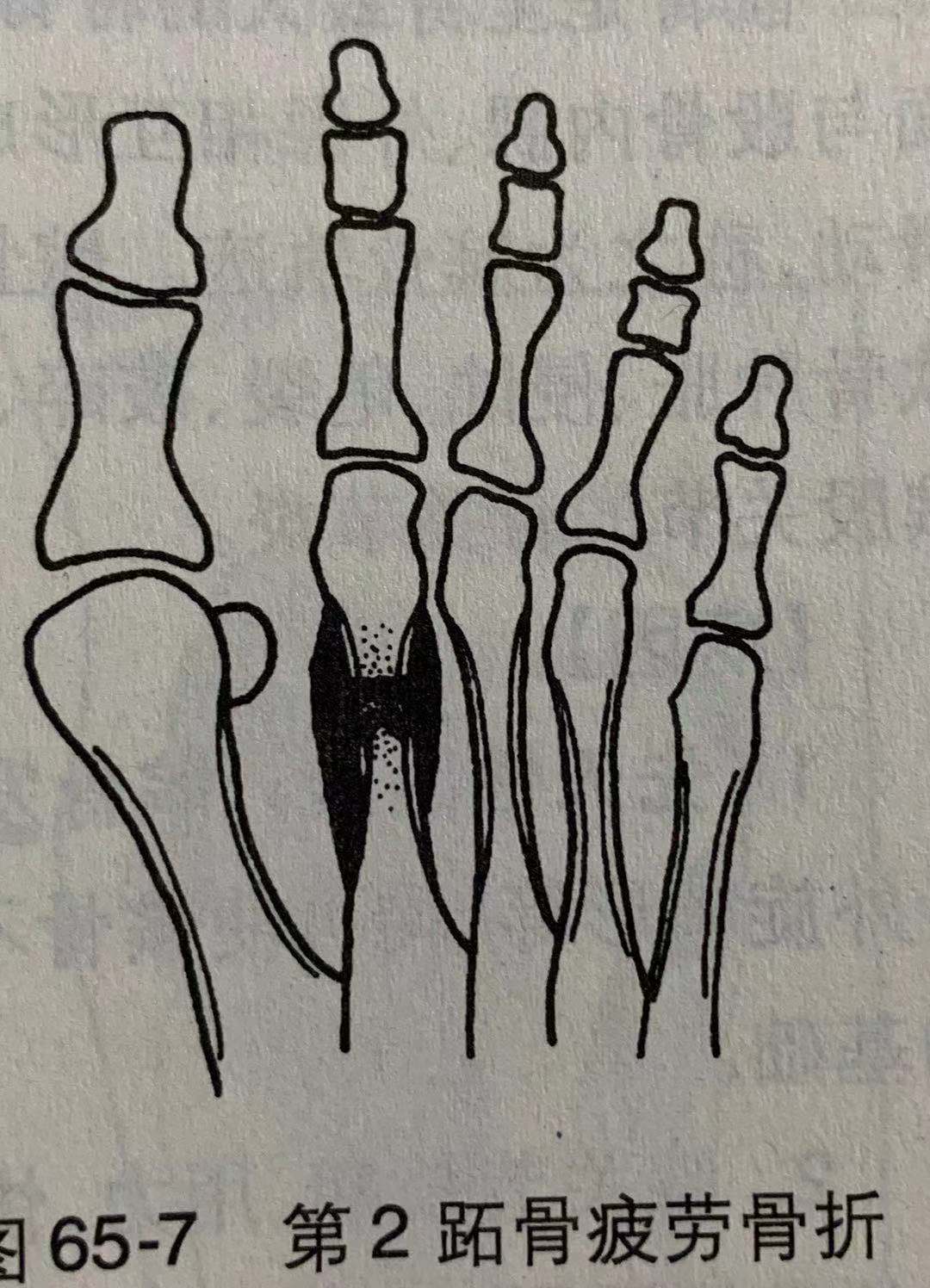 什么疲劳也会骨折